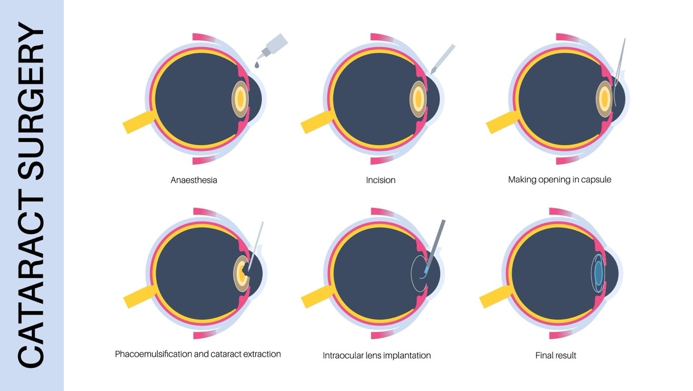 Comparison view showing cataract and post-surgery vision