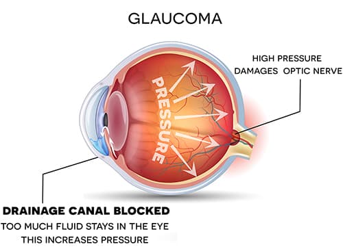 Glaucoma eye diagram